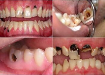 Bài thuốc chữa sâu răng