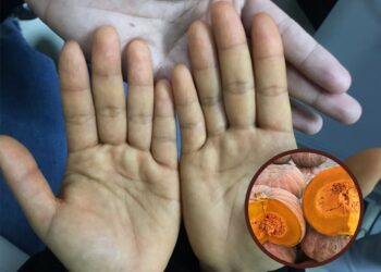 Tác hại của bí đỏ khiến vàng da